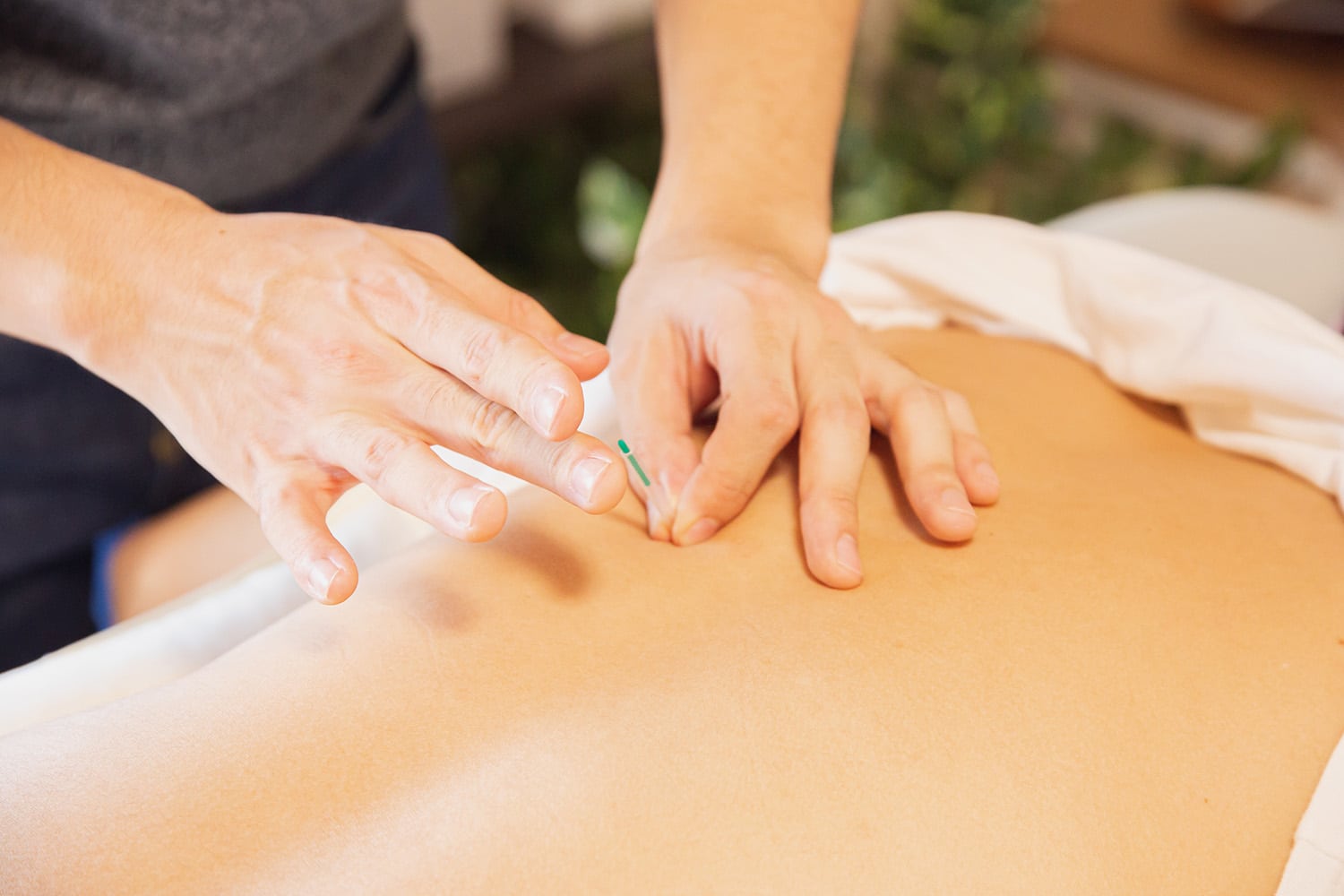 Patient receiving dry needling